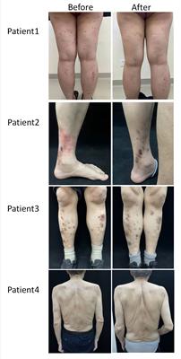 Dupilumab improve acquired reactive perforating collagenosis characterized by type 2 inflammation